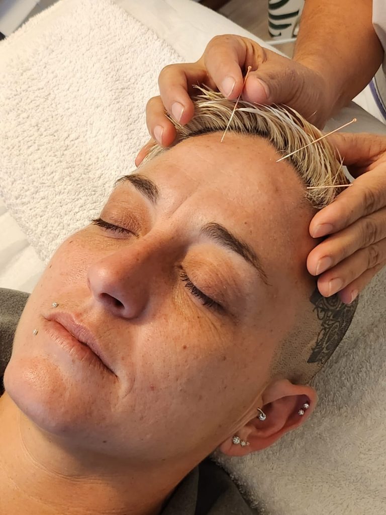 Tratamiento de creaneopuntura YNSA por Bertha Sánchez