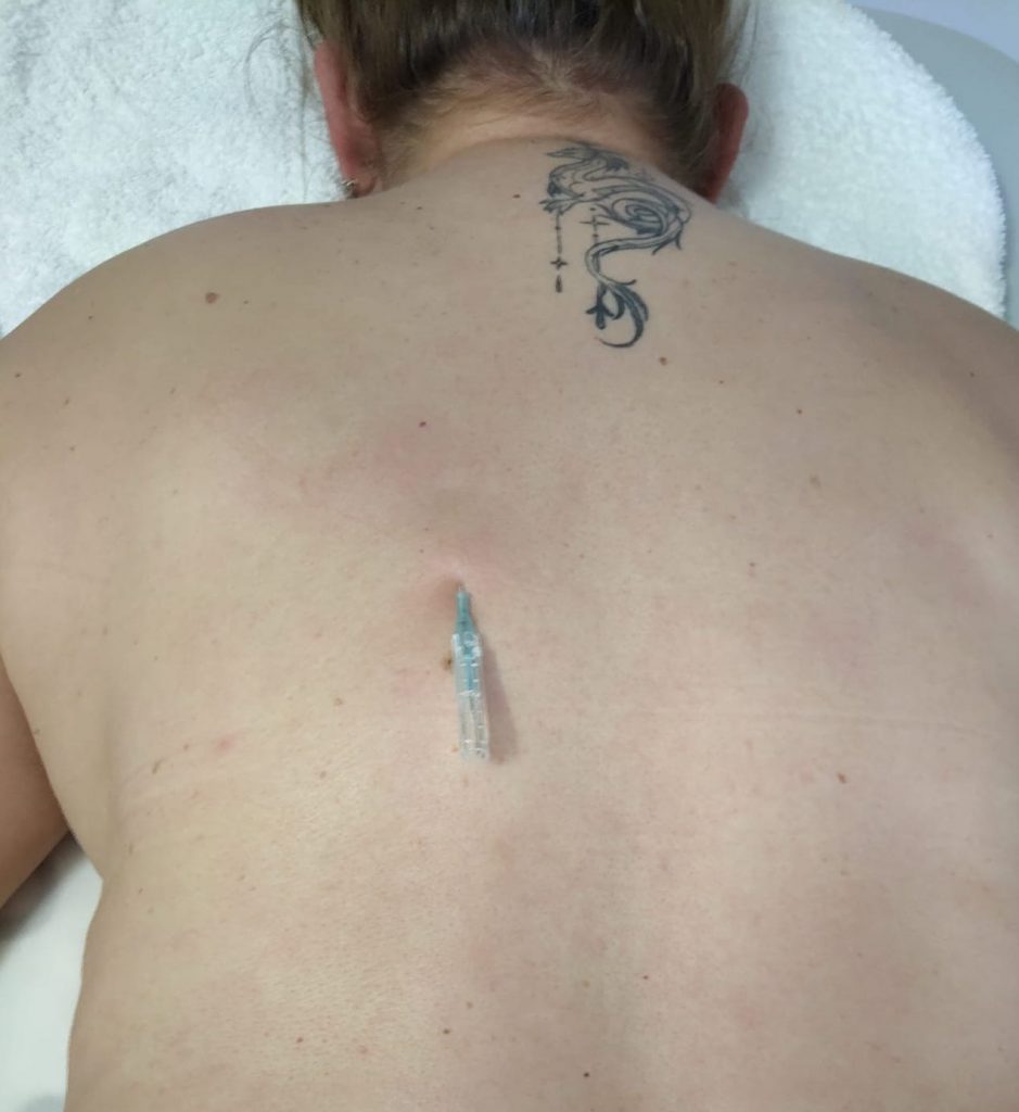 acupuntura subcutánea Fu Zhen por Bertha Sánchez Osteópata